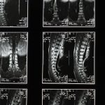 Sténose spinale lombaire : comment la décompression neurovertébrale peut aider 8 découvrez tout ce qu'il faut savoir sur la sténose spinale lombaire : symptômes, causes, diagnostic et traitements. informez-vous sur les options pour soulager la douleur et améliorer votre qualité de vie.