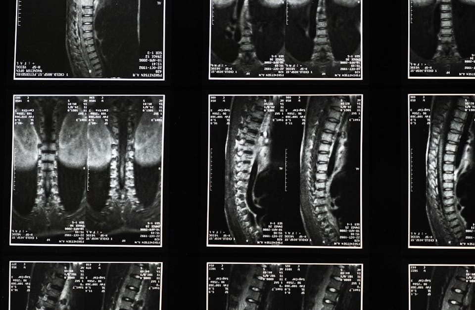 découvrez les bienfaits de la décompression neuro-spinale, une approche innovante pour soulager la douleur, améliorer la mobilité et favoriser la guérison du dos. apprenez comment cette technique non invasive peut transformer votre qualité de vie.