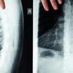 découvrez tout sur le diagnostic de la sténose spinale, une condition qui peut provoquer des douleurs et des problèmes de mobilité. apprenez-en plus sur les signes, les examens médicaux et les options de traitement disponibles pour améliorer votre qualité de vie.