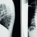 découvrez la décompression spinale, une technique thérapeutique innovante visant à soulager les douleurs dorsales et cervicales. apprenez comment cette méthode non invasive peut améliorer votre bien-être et favoriser une meilleure santé vertébrale.