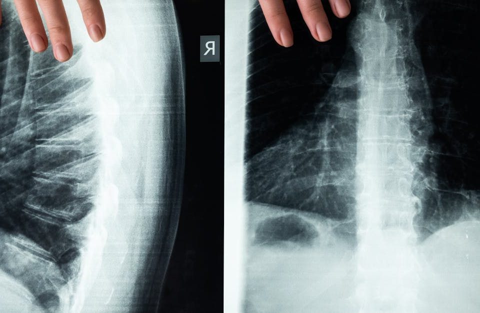 découvrez la décompression spinale, une technique innovante visant à soulager les douleurs lombaires et cervicales. apprenez comment elle fonctionne, ses bénéfices, et pourquoi de plus en plus de personnes choisissent cette approche pour améliorer leur qualité de vie.