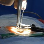 la sténose spinale est un rétrécissement du canal vertébral qui peut entraîner des douleurs et des engourdissements. découvrez ses causes, symptômes et traitements pour améliorer votre qualité de vie.