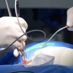 découvrez les causes, symptômes et traitements de la sténose foraminale, une affection vertébrale courante qui peut provoquer des douleurs et des engourdissements. informez-vous sur les options de gestion et d'amélioration de la qualité de vie.