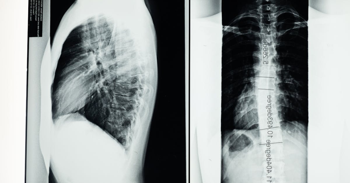 découvrez la décompression spinal, une technique innovante pour soulager les douleurs dorsales et améliorer la santé de votre colonne vertébrale. apprenez comment ce traitement peut vous aider à retrouver votre mobilité et votre bien-être.