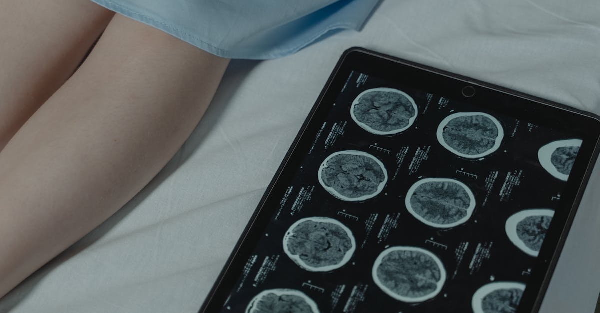 Les étapes pour planifier efficacement un traitement de décompression neurovertébrale pour un pincement discal complexe 8 découvrez ce qu'est la décompression neurologique, une technique médicale utilisée pour soulager la pression sur les nerfs et améliorer la qualité de vie des patients atteints de troubles neurologiques.