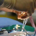 découvrez ce qu'est la sténose foraminale, ses causes, symptômes et traitements. informez-vous sur les solutions pour soulager la douleur et améliorer votre qualité de vie.